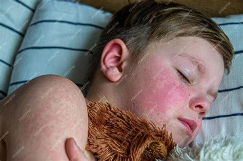 Premium Photo | Viral disease Measles rash on the body of the child Allergy