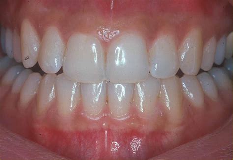 healthy  unhealthy gums  visual guide instafloss