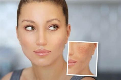 ¿Qué es el paño en la cara? Cómo prevenir y quitar el melasma | Eternia ...