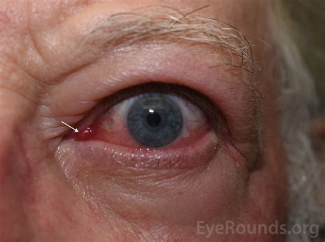 Lacrimal Punctum Swollen