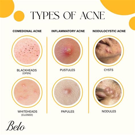 understanding acne common types  triggers