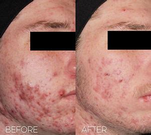 BEFORE & AFTER | The Calgary ACNE Clinic