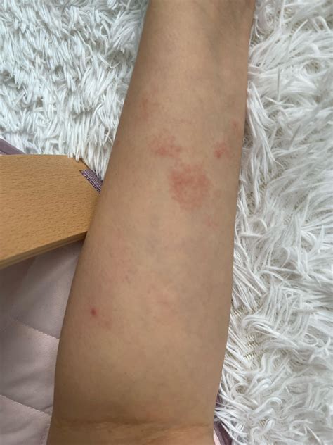 Eczema or bacterial? : r/infectiousdisease