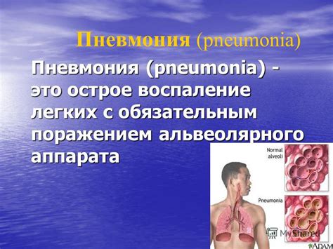 Презентация На Тему Пневмония - scubainstrukciya