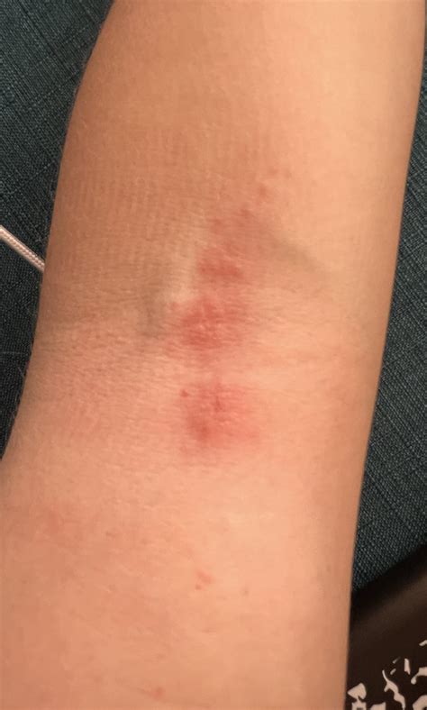 Rash or Bug Bite Reaction? : r/DermatologyQuestions