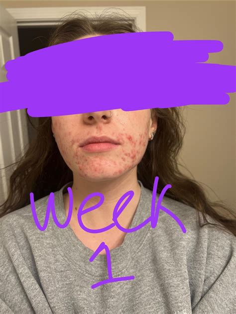 Do you see any type of improvement? I know it’s early days but it’s