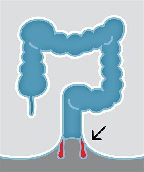 Rectal Prolapse Treatment - Gastroenterology Of The Rockies
