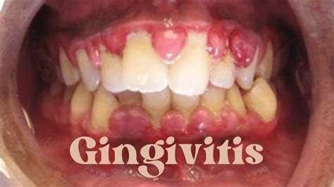 Gingivitis: Causes, Symptoms, and Prevention