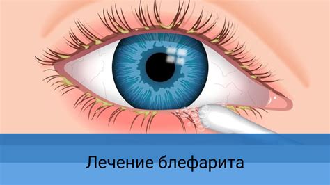 Блефарит - лечение, причины и симптомы заболевания