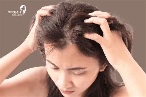 Dandruff Control: Effective Tips and Remedies for a Flake-Free Scalp - Hunter Games Magazine