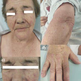 Dermatomyositis skin rash (a) V-sign and heliotrope/facial erythema ...