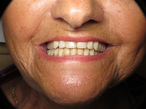 Dental Bone Graft Failure Signs at Ruby Hereford blog