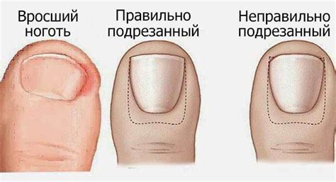 Лечение вросшего ногтя