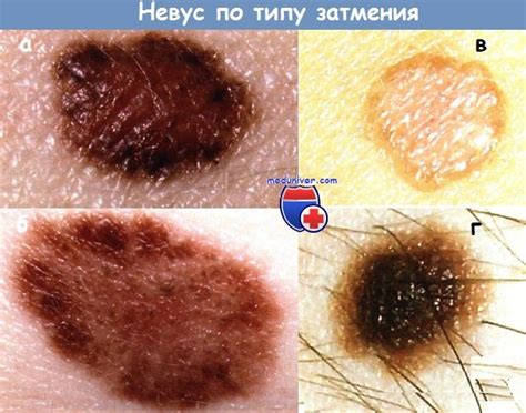 Меланоформный невус: признаки, фото, лечение, причины появления