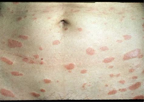 pityriasis rosea | Simple Remedies
