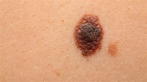 melanoma skin cancer