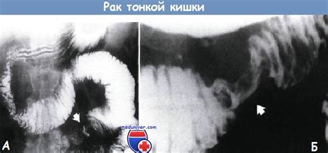 Рак (аденокарцинома) тонкой кишки - диагностика