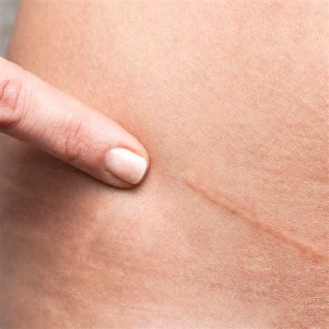 natural ingredients   minimise scars sage cosmetic coaching