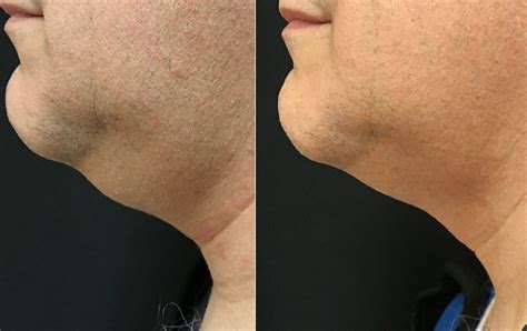 Milwaukee double chin treatment - Non-invasive body sculpting services ... 