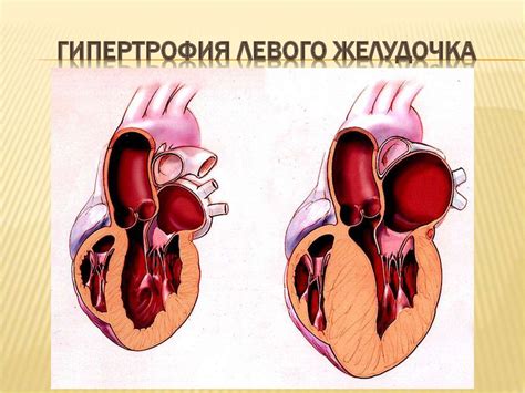 ЭКГ при гипертрофии миокарда - презентация онлайн