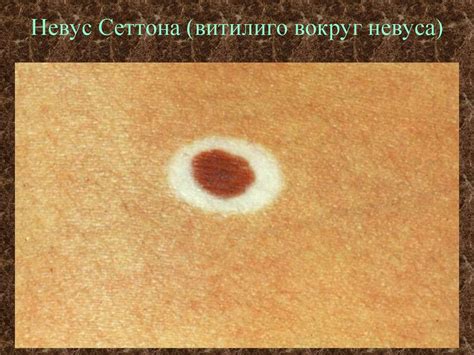 Морфологические элементы кожных сыпей - презентация онлайн