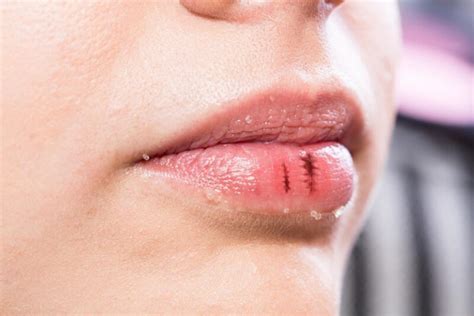 Lábio Inchado E Dormente - Inflamação dos lábios: causas, sintomas e tratamentos