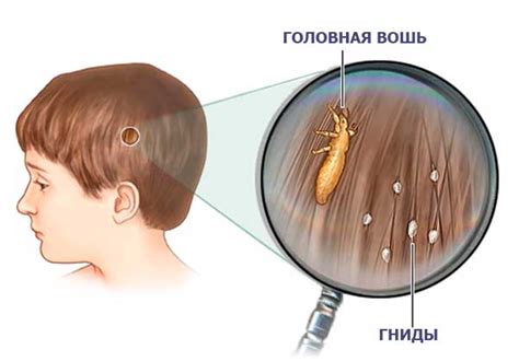 Лечение и профилактика педикулеза у детей