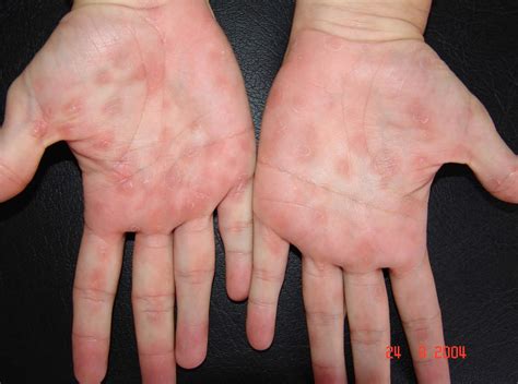 Syphilis stages, signs, symptoms, diagnosis, treatment and syphilis cure
