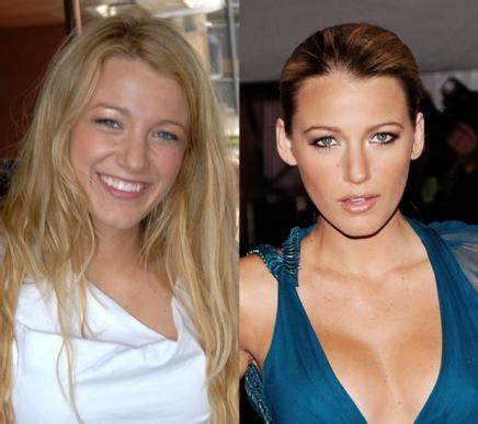 Blake Lively Nose Job Before And After
