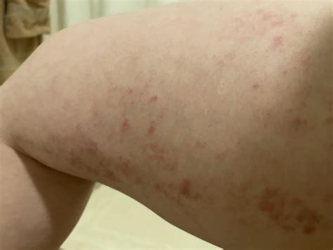 Doctors of Reddit, what is this mysterious rash? : r/Dermatology