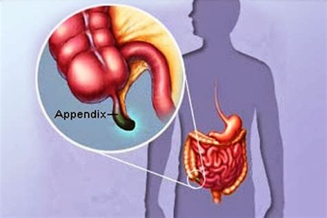 Gejala-gejala Awal Penyakit Usus Buntu (Apendisitis) | Medical Line