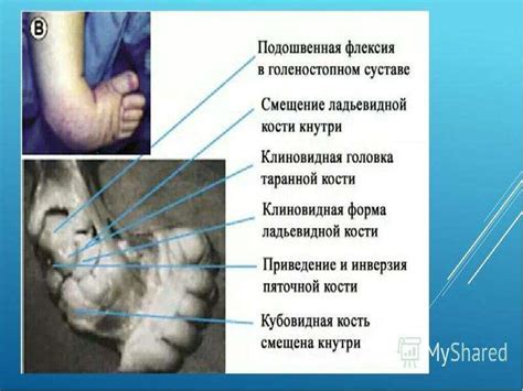 Врожденная косолапость - презентация, доклад, проект скачать