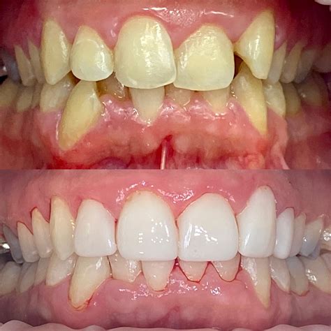 Before and After Gallery | Bespoke Dental Fulham
