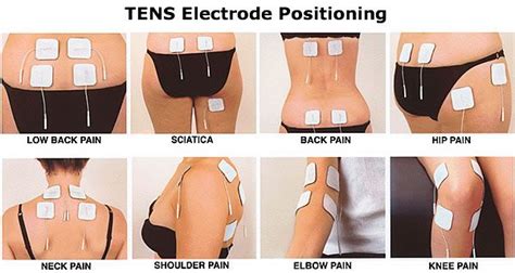 Tens unit sciatica electrode placement – Artofit