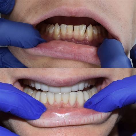 Before and After Veneers Procedure | Dr. Christian Chung, D.D.S.