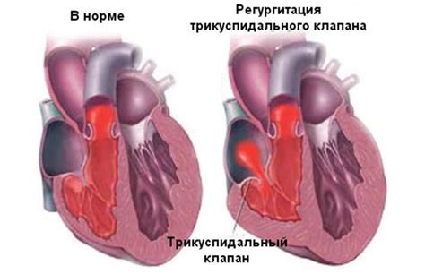 Недостаточность и стеноз трикуcпидального клапана: что это, причины ...