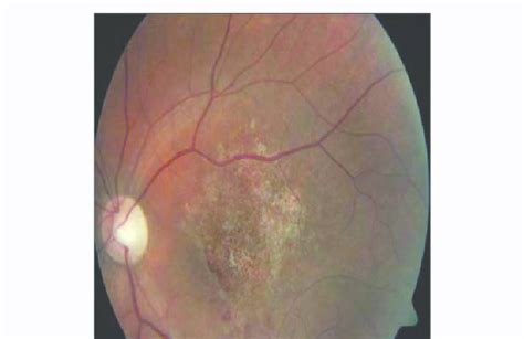 Case 2, fundoscopic examination. | Download Scientific Diagram
