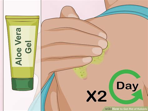 3 Ways to Get Rid of Keloids - wikiHow