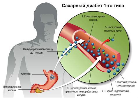 Разница между Диабетом 1 и 2 типа