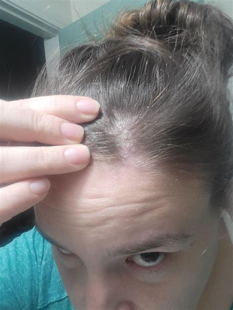 Does this appear to be seb derm or possibly psoriasis? I am at my wits