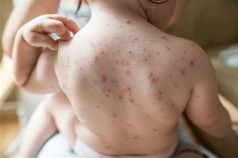 Varicella-Zoster Virus - Infectious Disease Advisor