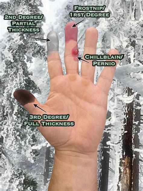 Recognizing Frostbite : r/Survival