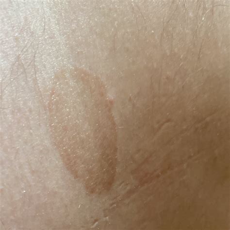 Pityriasis Versicolor (ICD-11: 1F2D / ICD-10: B36) ⚠️ - Online AI
