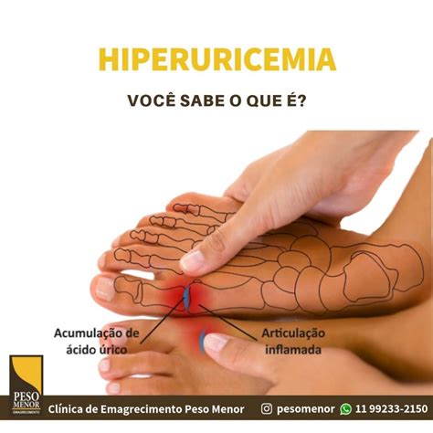 O Que É Hiperuricemia - A Hiperuricemia Primária Pode Ser Decorrente De - RETOEDU