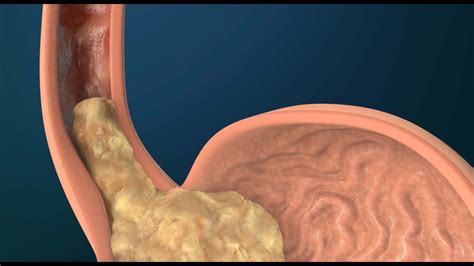 What Causes GERD? - YouTube