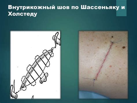 Кожный шов и основы пластической хирургии - презентация онлайн