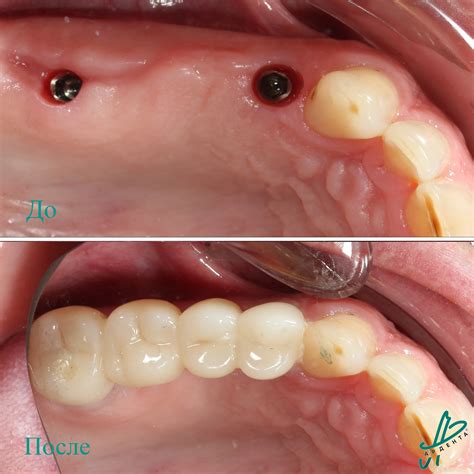 Импланты дентиум Dentium Superline в стоматологии Ардента в Ростове-на ...