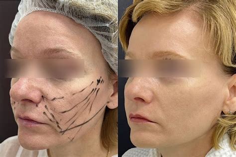 Нитевой лифтинг лица в Москве — VIP Clinic. Подтяжка лица без операции ...