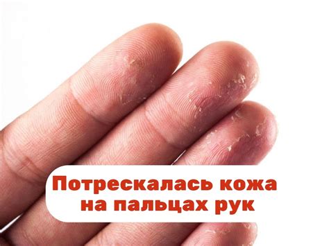 Потрескалась кожа на пальцах рук: причины, лечение