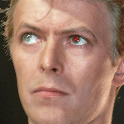 David Bowie Heterochromia